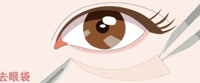 医美技术？多少钱会再长吗后遗症医生爱游戏体育眼袋去除有什么比较好的(图2)